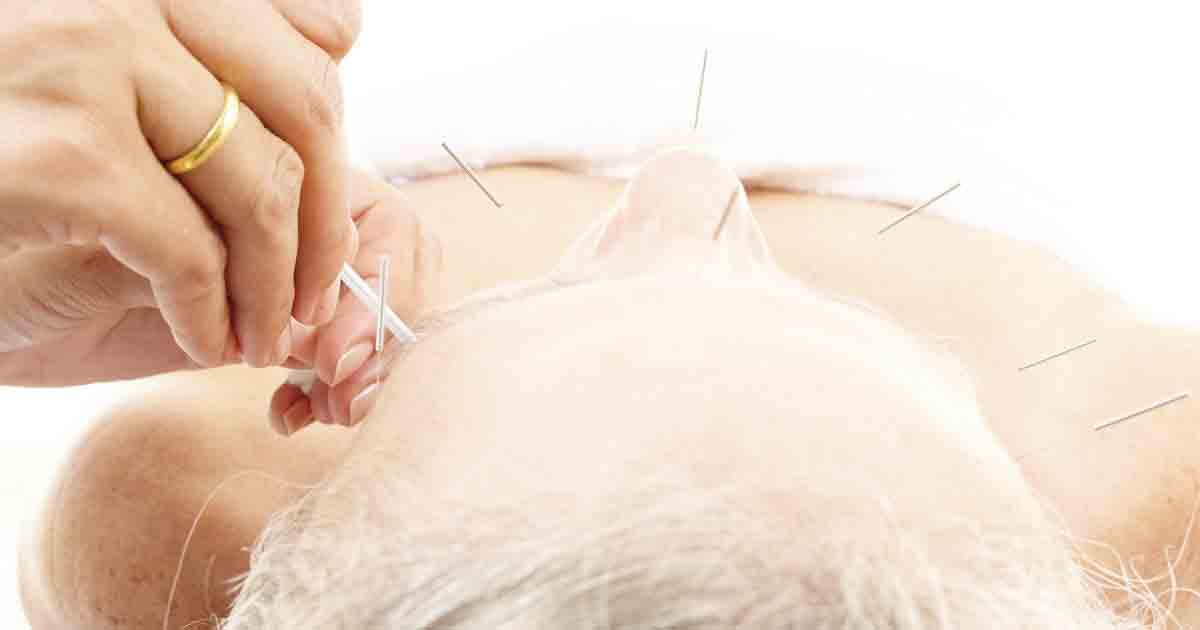 Senior woman getting acupuncture, to represent how acupuncture treatments help with pain