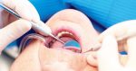 Find Coverage for Dental Care in Retirement