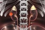Are You at Risk for Kidney Disease?