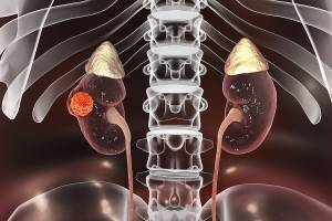 Kidney disease concept image